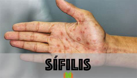 doença sífilis fotos